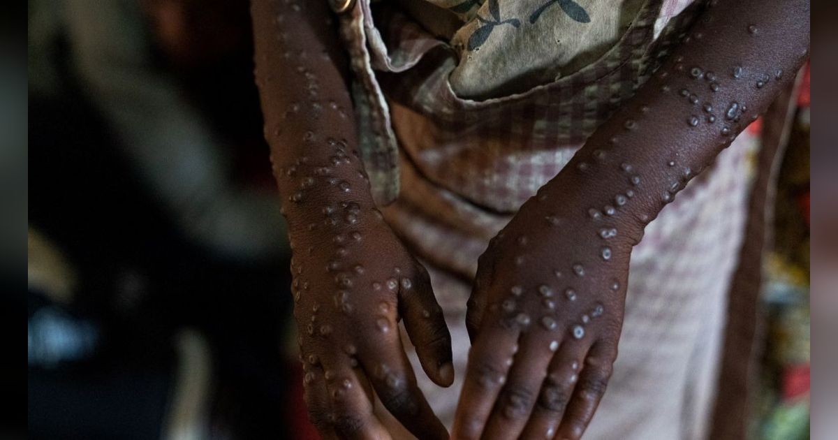 FOTO: Lonjakan Varian Baru Mpox atau Cacar Monyet Meluas, Penyebaran Virus Sudah ke Asia dan Eropa