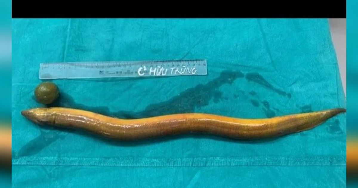 Viral Dokter Keluarkan Belut 'Hidup' dari Perut Manusia, Panjangnya 60 Sentimeter