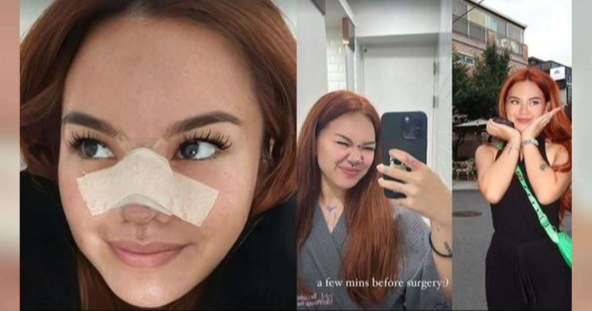 Potret Shafa Harris Oplas Hidung di Korea Selatan, Ambil Tulang dari Iga dan Wajah Minim Bengkak