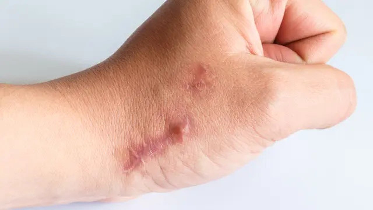 Keloid / Sumber: iStockphoto
