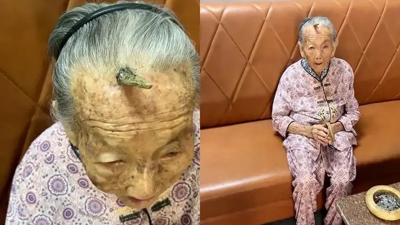 Dahi Nenek 107 Tahun Ini Tumbuh Tanduk (Sumber:Douyin via New York Post)