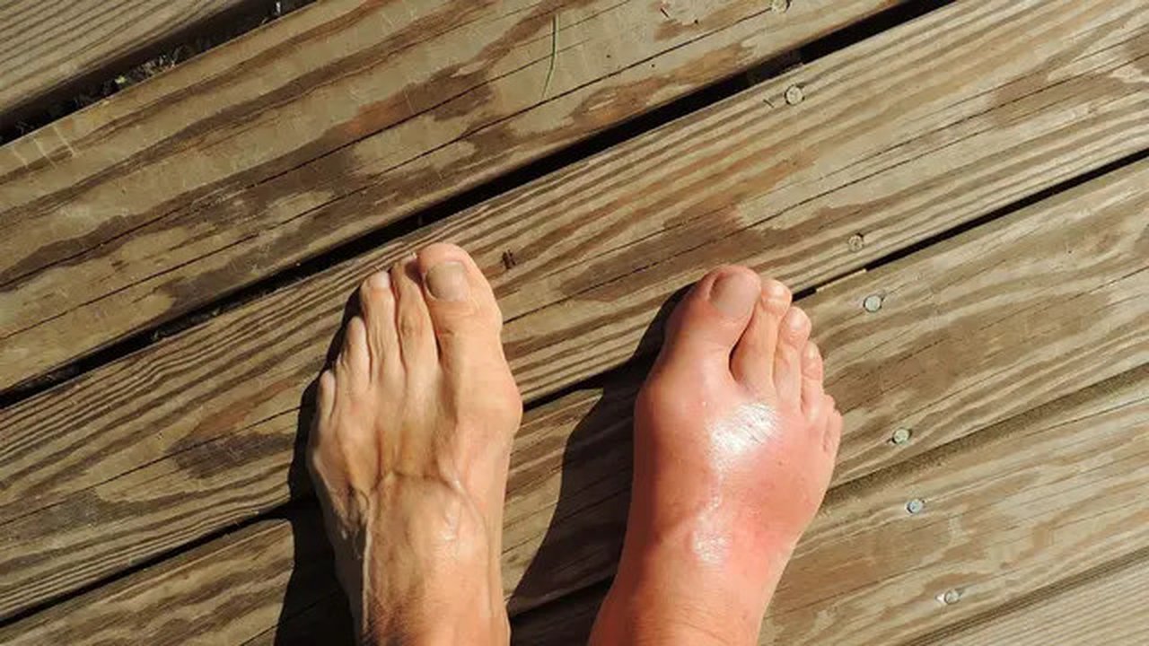 cara menurunkan asam urat (foto: Pixabay)