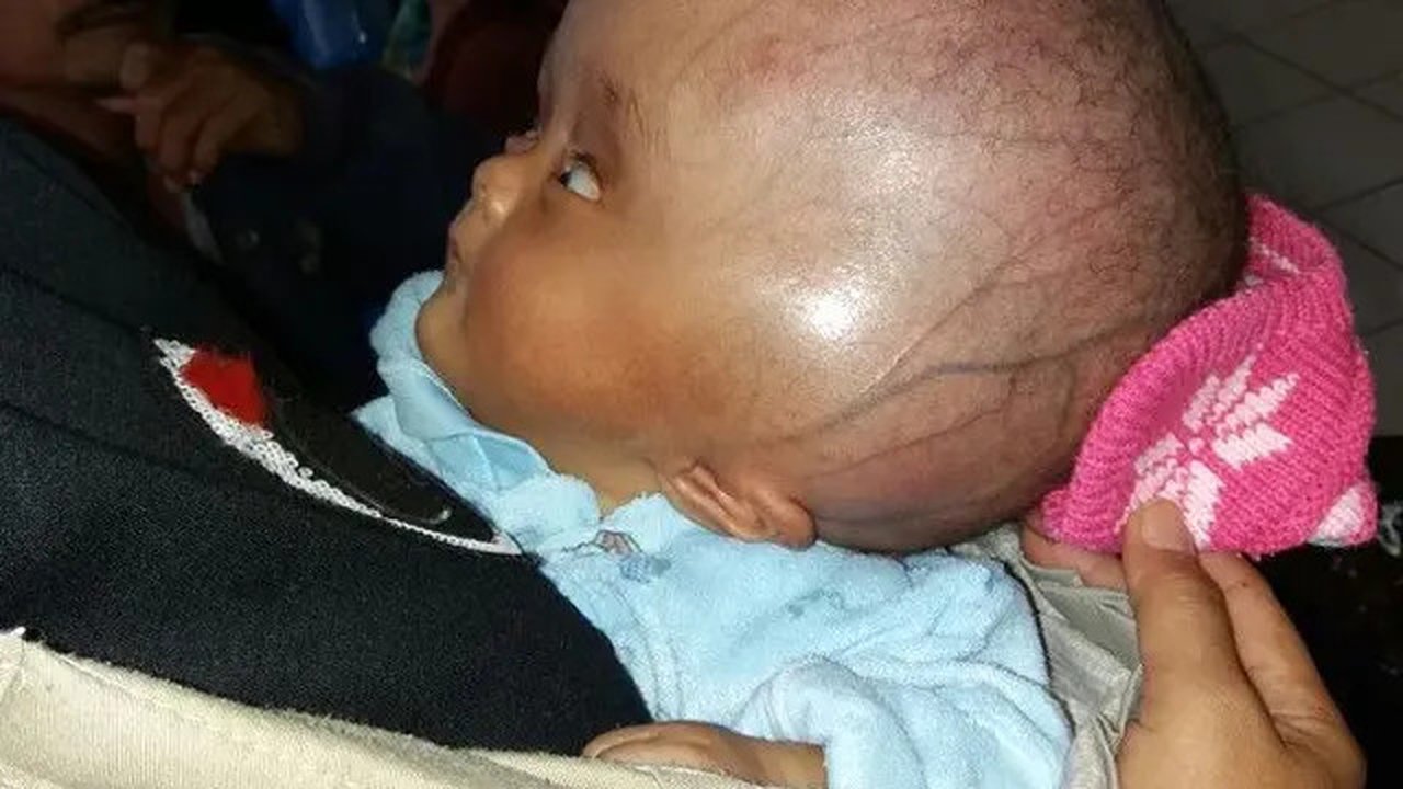 Bayi pengidap hidrosefalus bernama Husen, ditinggalkan kembarannya Hasan yang meninggal lebih dahulu saat dilahirkan. (Liputan6.com/Jayadi Supriadin)