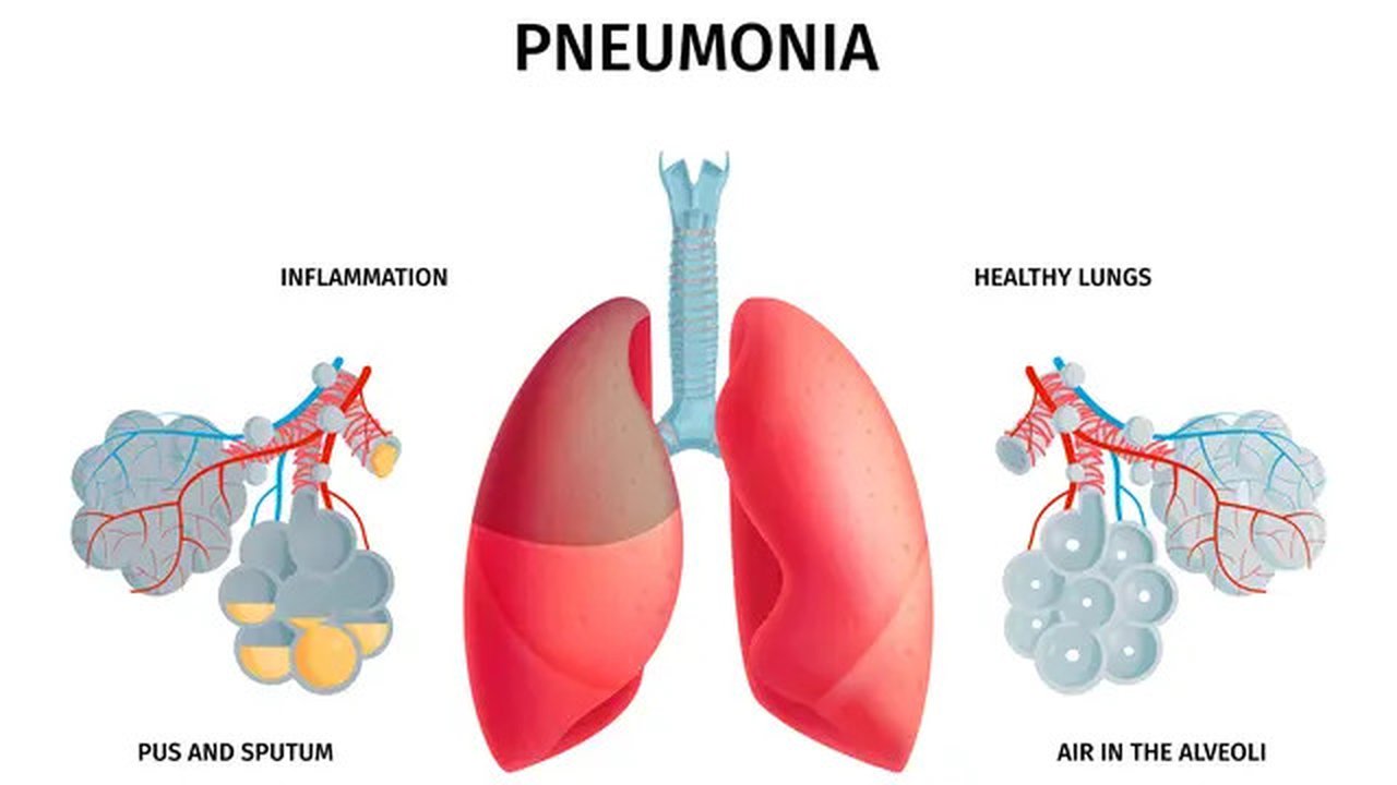 Ilustrasi pneumonia. (Image by macrovector on Freepik)