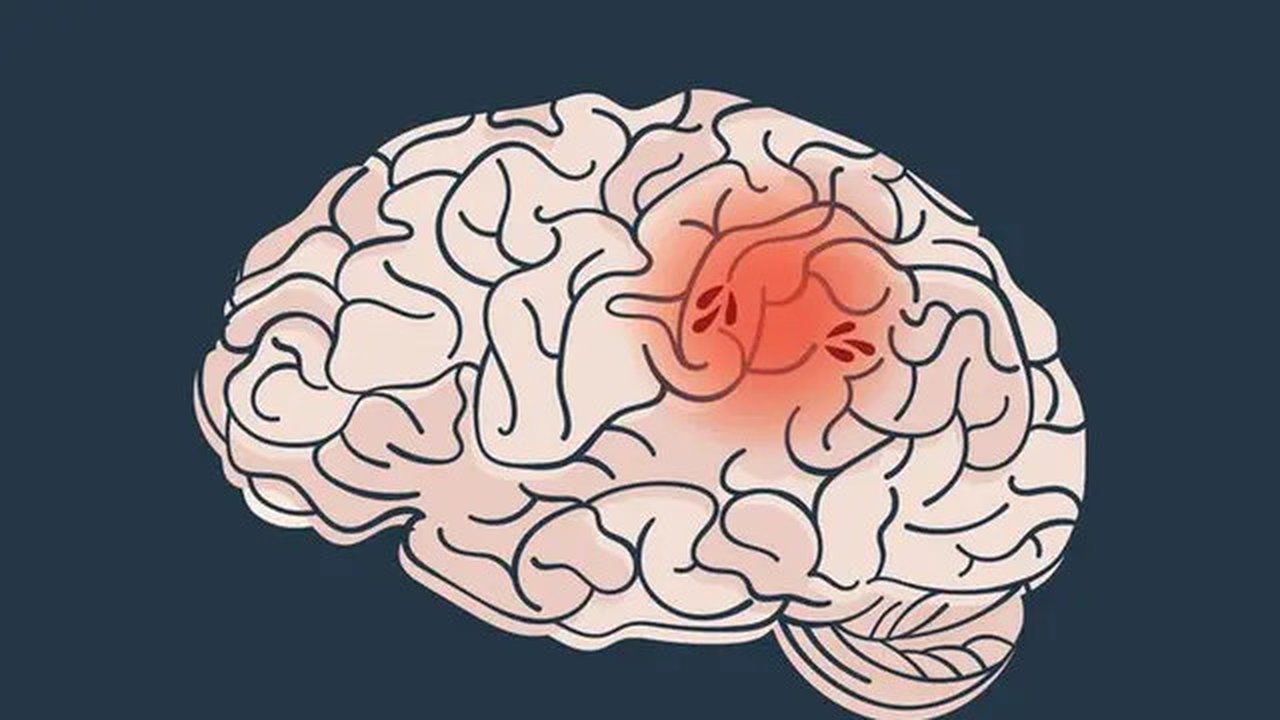 Stroke. (foto: Pinterest).
