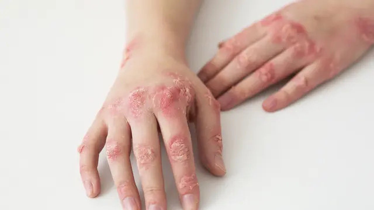 Ilustrasi impetigo. Foto: Freepik.