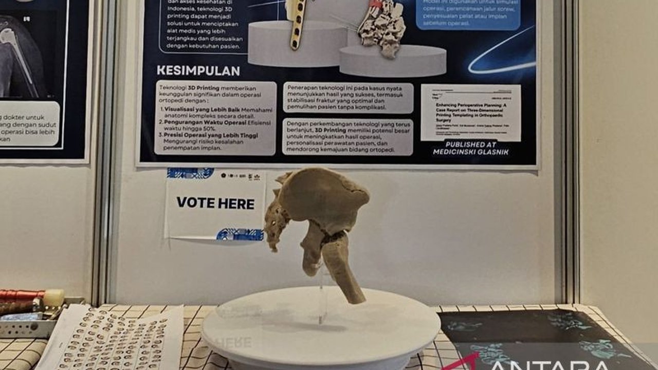 Fakultas Kedokteran Universitas Brawijaya (FK UB) mendorong penggunaan teknologi 3D printing dalam operasi ortopedi untuk meningkatkan akurasi dan mempercepat proses penyembuhan pasien patah tulang dan dislokasi.