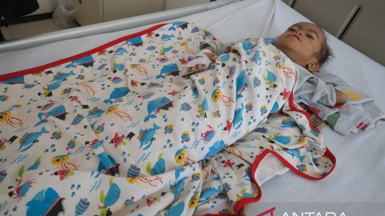 Balita Gizi Buruk di Kendari, Butuh Perhatian Pemerintah