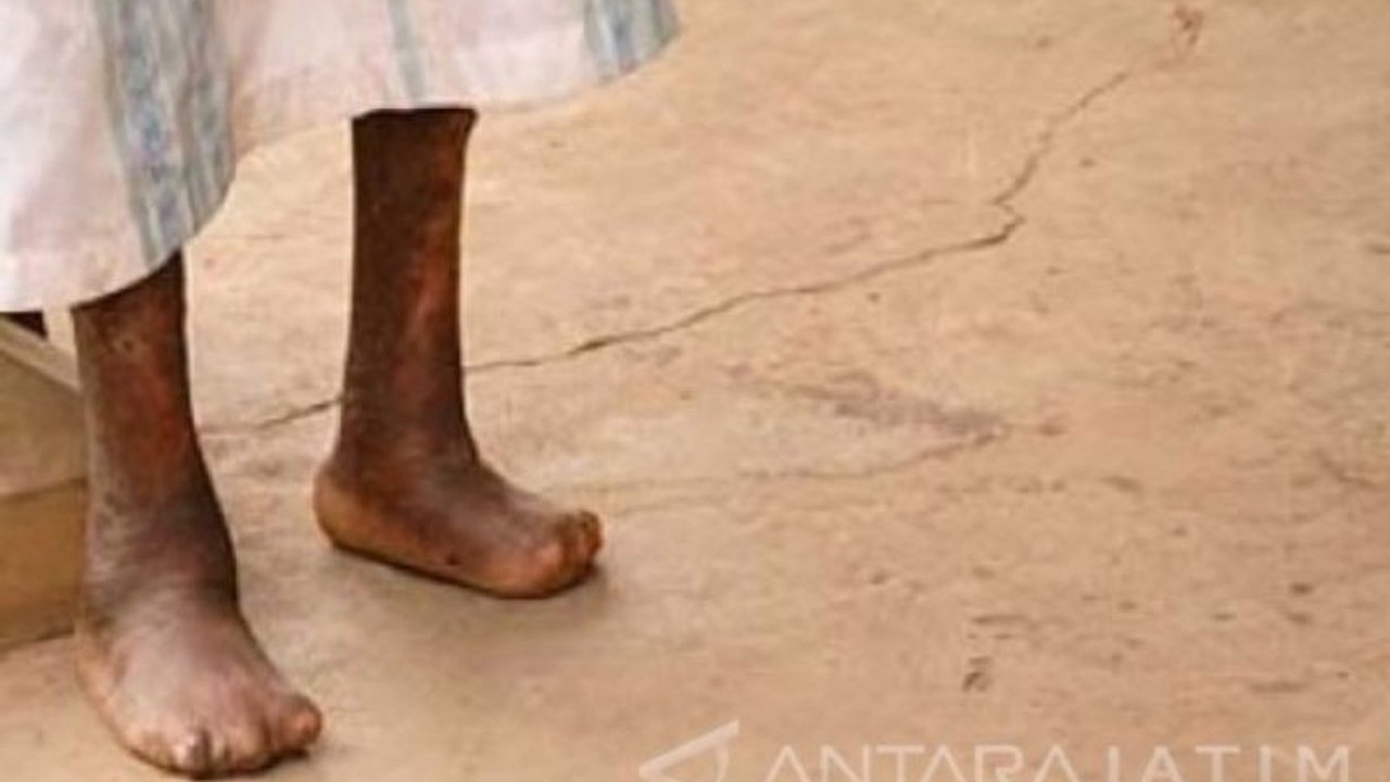 Pentingnya edukasi di sekolah dan media sosial untuk menghilangkan stigma negatif terhadap penyakit kusta serta meningkatkan kualitas hidup penderitanya.