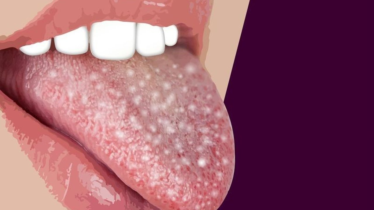 Sariawan lidah yang tak kunjung sembuh dalam 2 minggu, disertai lesi keputihan dan berulang di tempat sama, bisa jadi pertanda kanker lidah; segera konsultasi ke dokter THT!