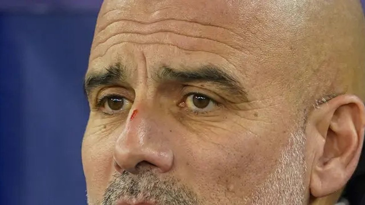 Manajer Man City, Pep Guardiola, terlihat mengalami luka goresan di hidungnya ketika berdiri di sisi lapangan menemani timnya bertanding melawan Feyenoord pada lanjutan Liga Champions 2024/20