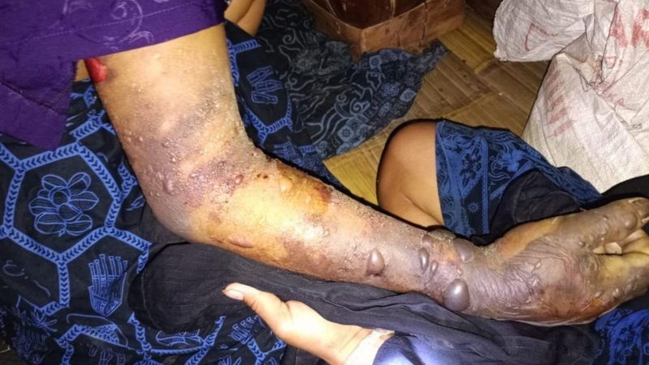 Relawan Sahabat Indonesia (SRI) menyelamatkan warga Badui yang menjadi korban gigitan ular tanah berbisa dan merujuk mereka ke RSUD Banten, menangani puluhan kasus serupa setiap tahunnya.