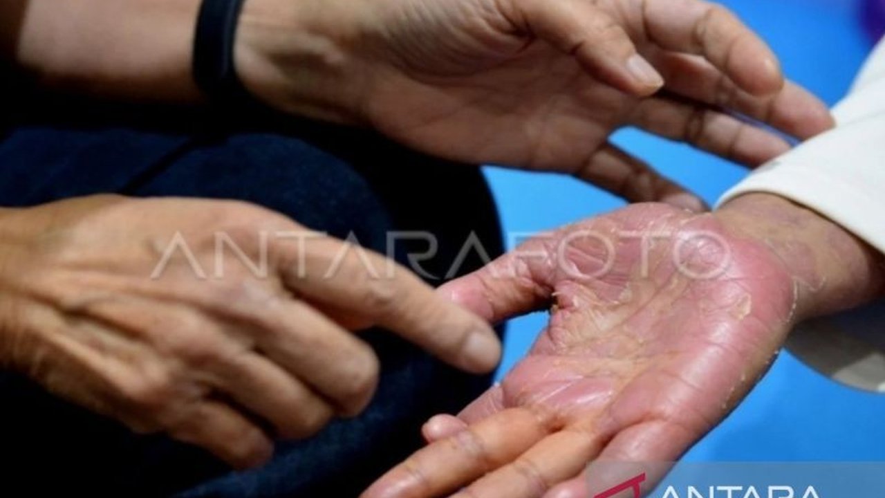 Sistem kekebalan tubuh yang menyerang sel tubuh sendiri, penyakit autoimun bukan menular, melainkan dipengaruhi genetik dan faktor lingkungan.