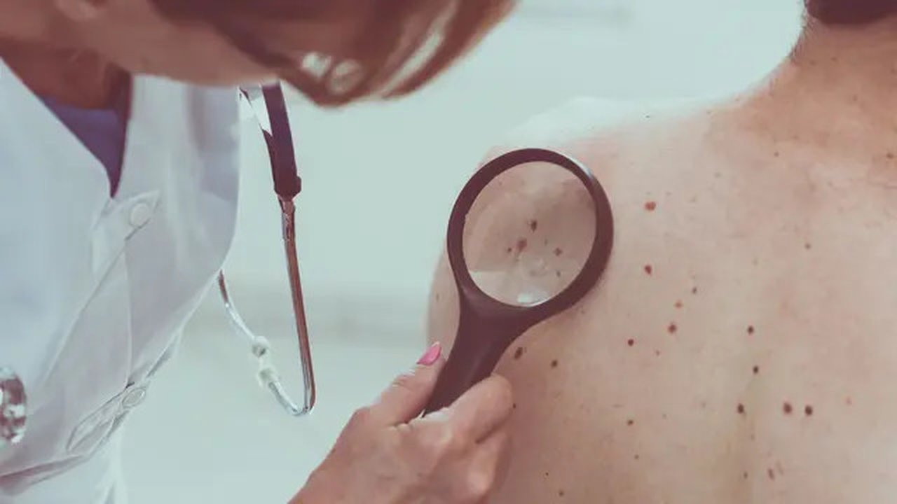 Ilustrasi kanker kulit (sumber: iStockphoto)