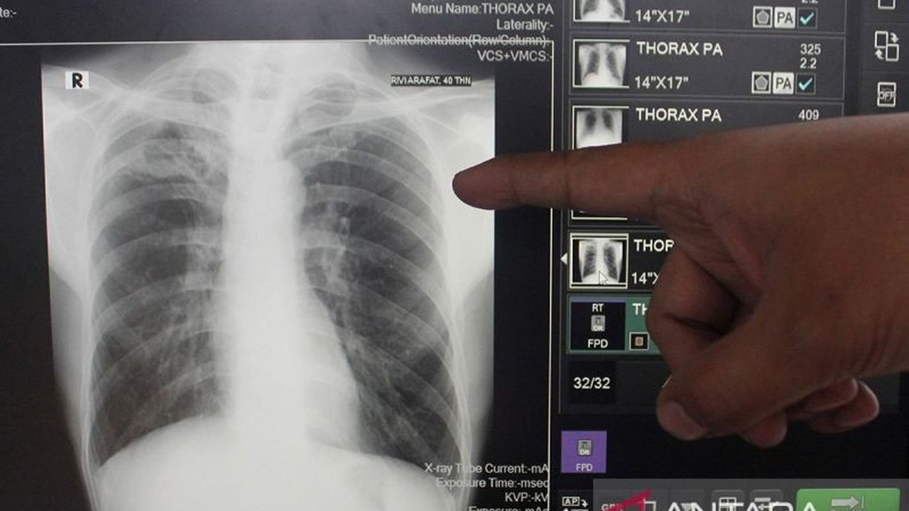 Dokter Rehab Medik RSUP Persahabatan sarankan latihan batuk efektif dengan metode huff cough untuk mempercepat pemulihan pasien tuberkulosis (TBC) dan meningkatkan kualitas hidup.