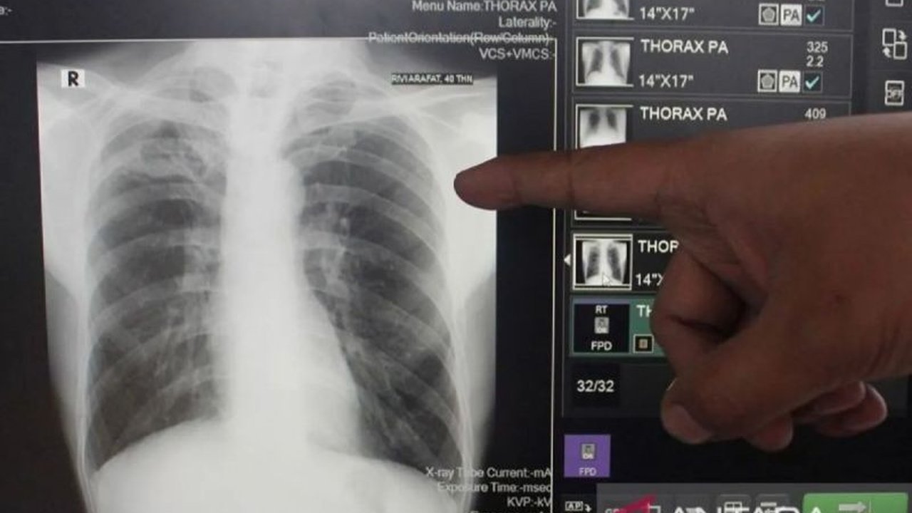 Sudinkes Jaktim Perkuat Juru Pemantau Batuk untuk Deteksi Dini TBC