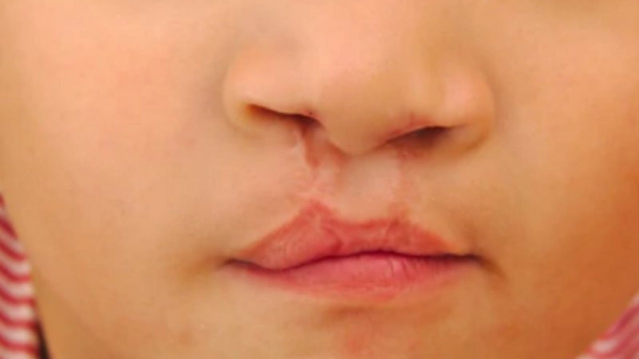 USG kini mampu mendeteksi bibir sumbing pada janin, memberikan kesempatan bagi orangtua untuk mempersiapkan perawatan sejak dini dan meminimalisir dampak jangka panjang.