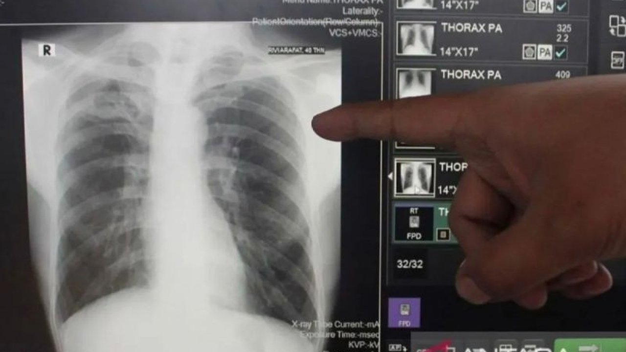 Pemkot Bandarlampung ungkap kepatuhan pasien dalam mengonsumsi obat TBC jadi kunci kesembuhan, dengan angka keberhasilan pengobatan mencapai 97 persen berkat obat kombinasi dosis tetap.