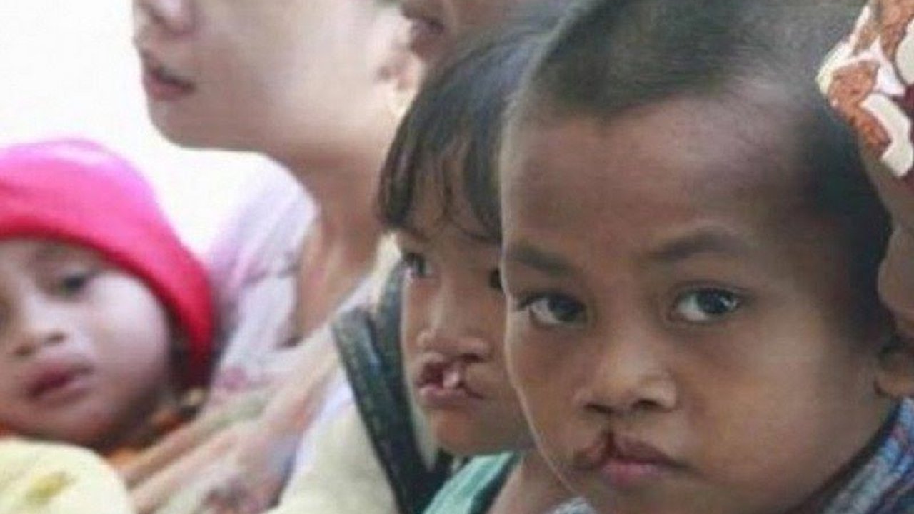 Kelainan bawaan bibir sumbing dan celah langit dapat mengganggu perkembangan fisik dan psikis anak, sehingga penanganan sejak dini sangat penting untuk meminimalisir dampak jangka panjang.