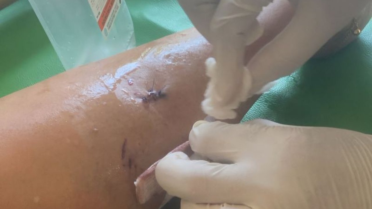 Seorang lansia di Tanjungpinang menjadi korban gigitan anjing liar. Dinkes setempat langsung memberikan penanganan medis intensif, memicu koordinasi lintas sektor untuk pencegahan.