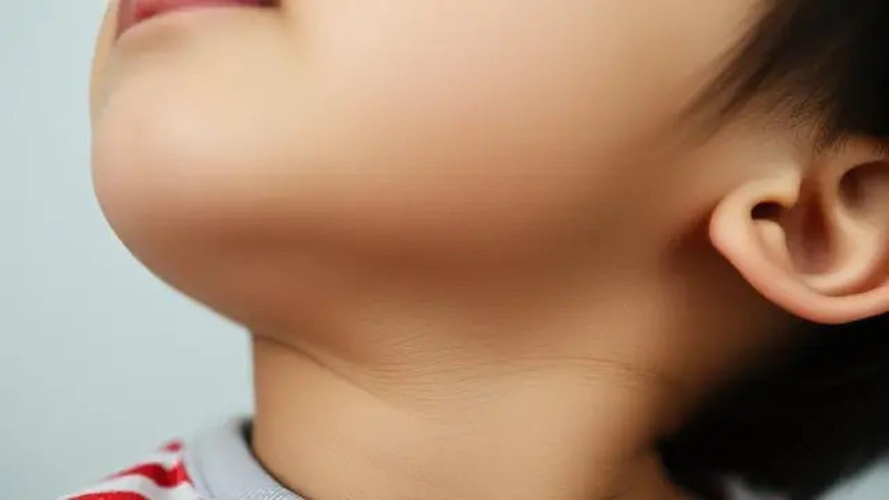 8 Gejala Radang Amandel, Salah Satunya Produksi Air Liur Berlebih. Foto dibuat oleh AI.