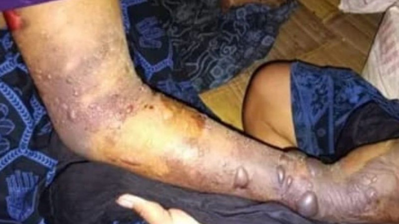 Tragedi gigitan ular berbisa menimpa warga Badui, menyebabkan tujuh kematian. Apa penyebab utama keterlambatan penanganan medis yang berujung fatal?