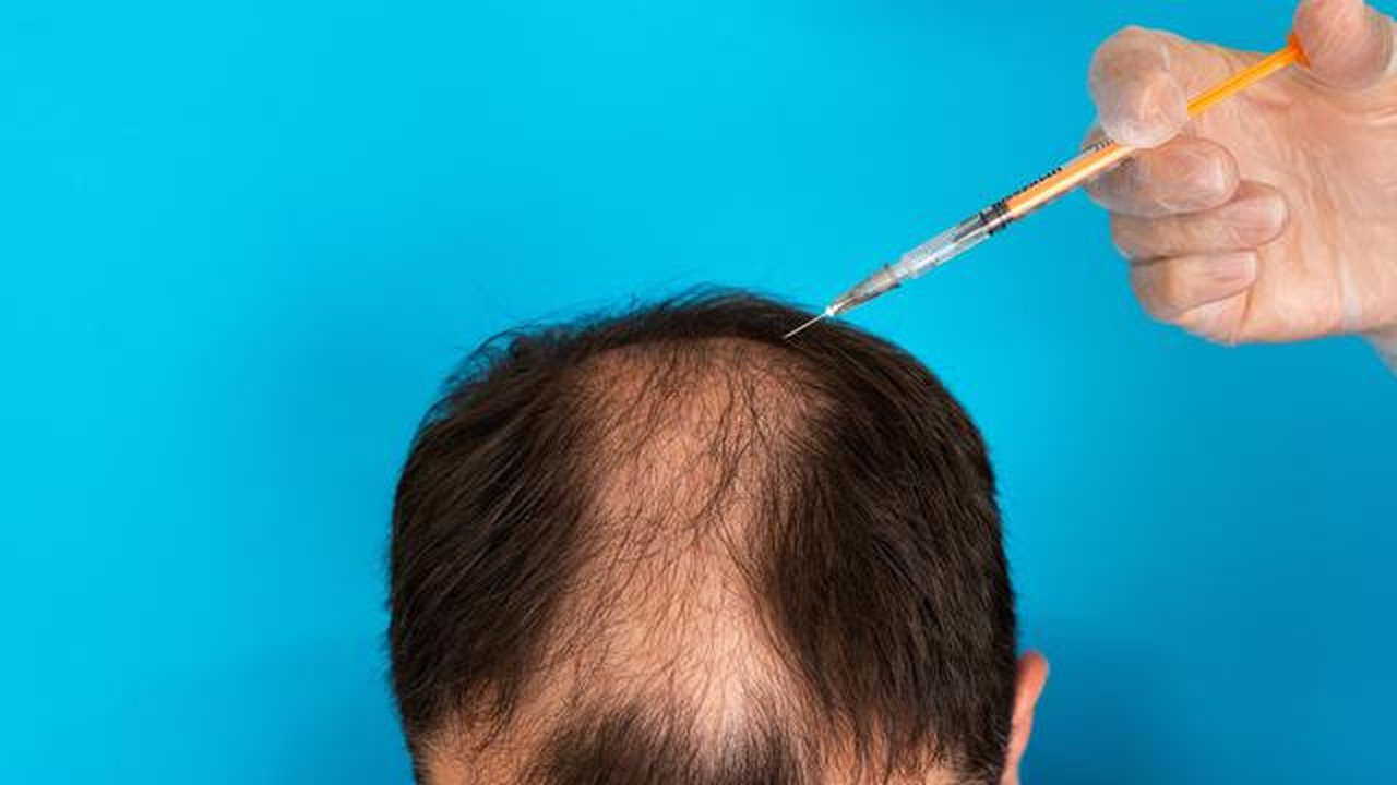 Ilustrasi seorang pria melakukan transplantasi rambut. (DepositPhotos.com/vfhnb12)