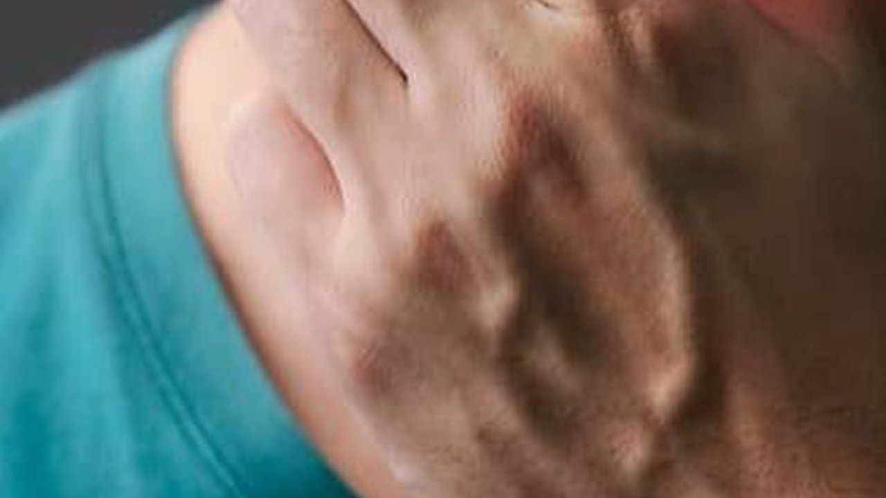 Ciri-ciri Difteri, Kenali Penyebab dan Cara Mencegahnya