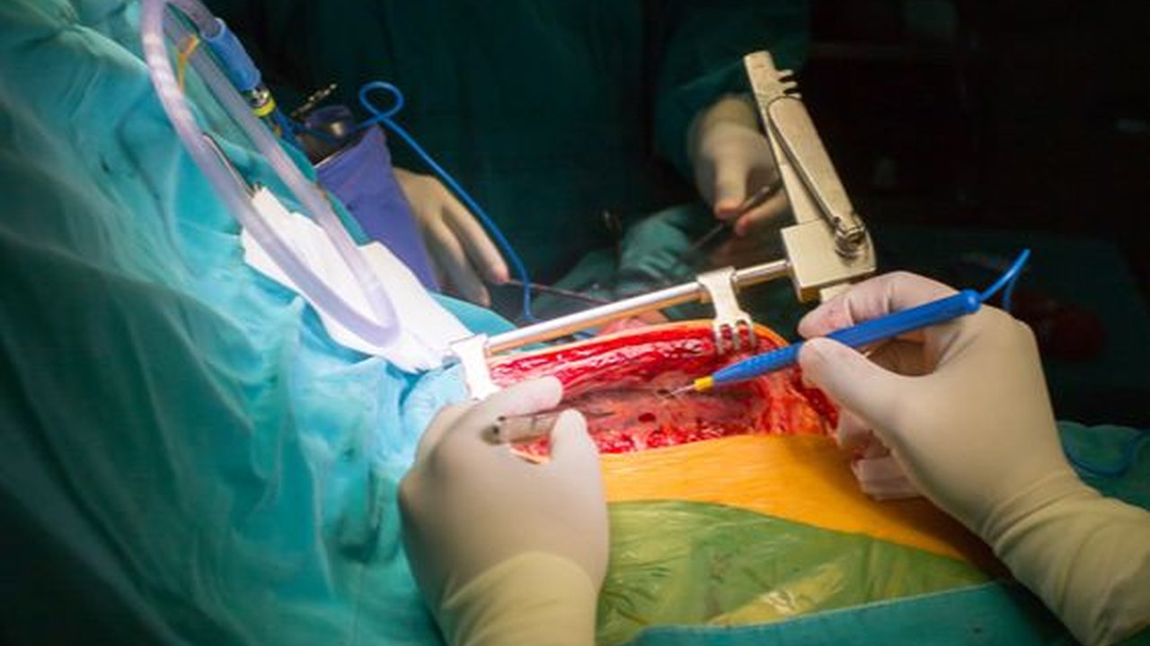 Operasi Bypass Jantung Koroner (CABG) Pertama di Purwabeka Sukses Ditangani RS EMC Cikarang