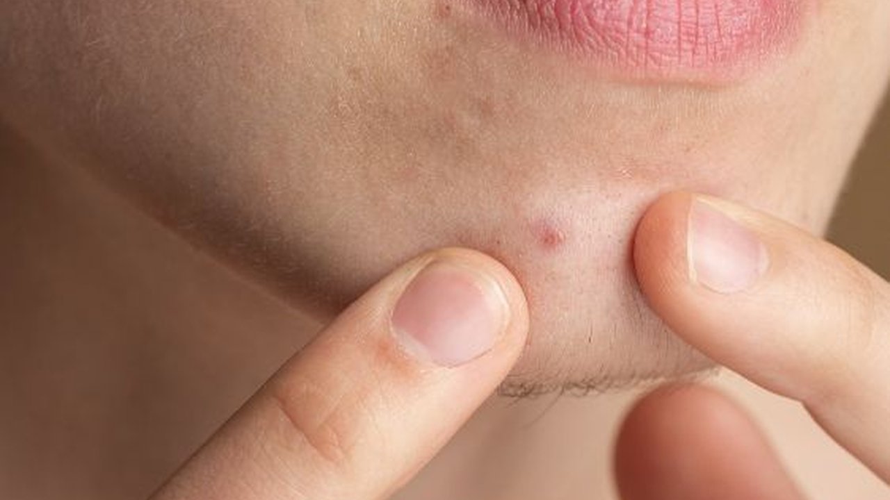 Makanan Penyebab Bisul yang Wajib Dihindari, Jangan Asal Makan