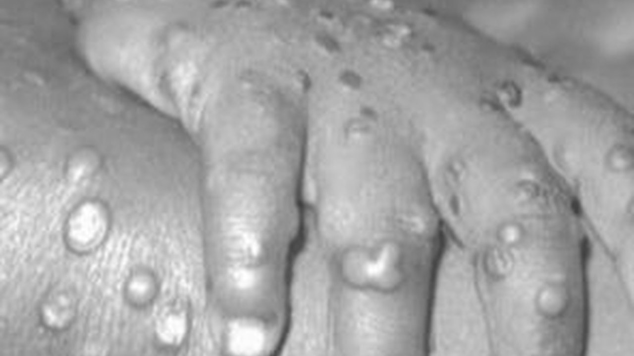 Kondisi Terkini Pasien Cacar Monyet yang Diisolasi di Jakarta