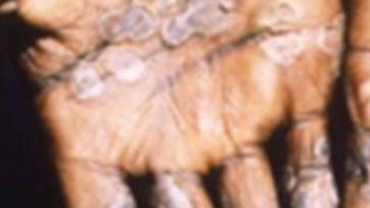 Kasus Cacar Monyet Meningkat, Kemenkes Sebut Mayoritas Pasien Punya Orientasi Biseksual
