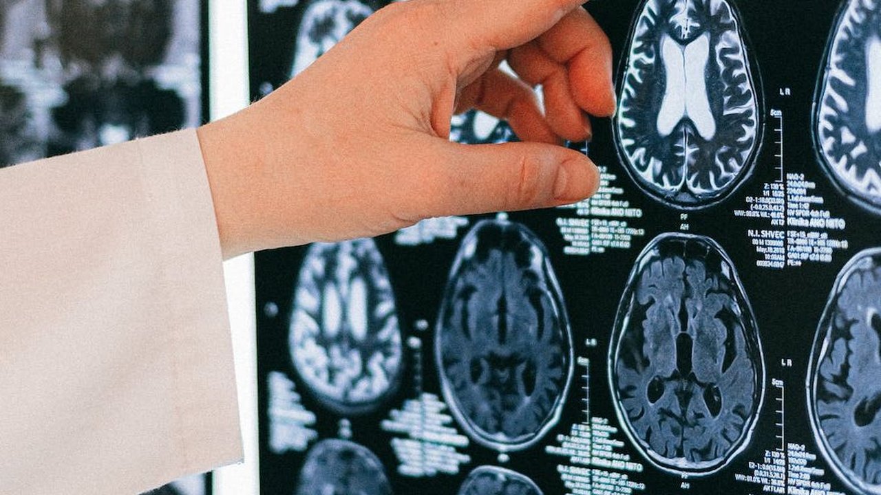 Gejala Stroke Biasanya Muncul Secara Mendadak Berupa Rasa Kesemutan di Satu Sisi