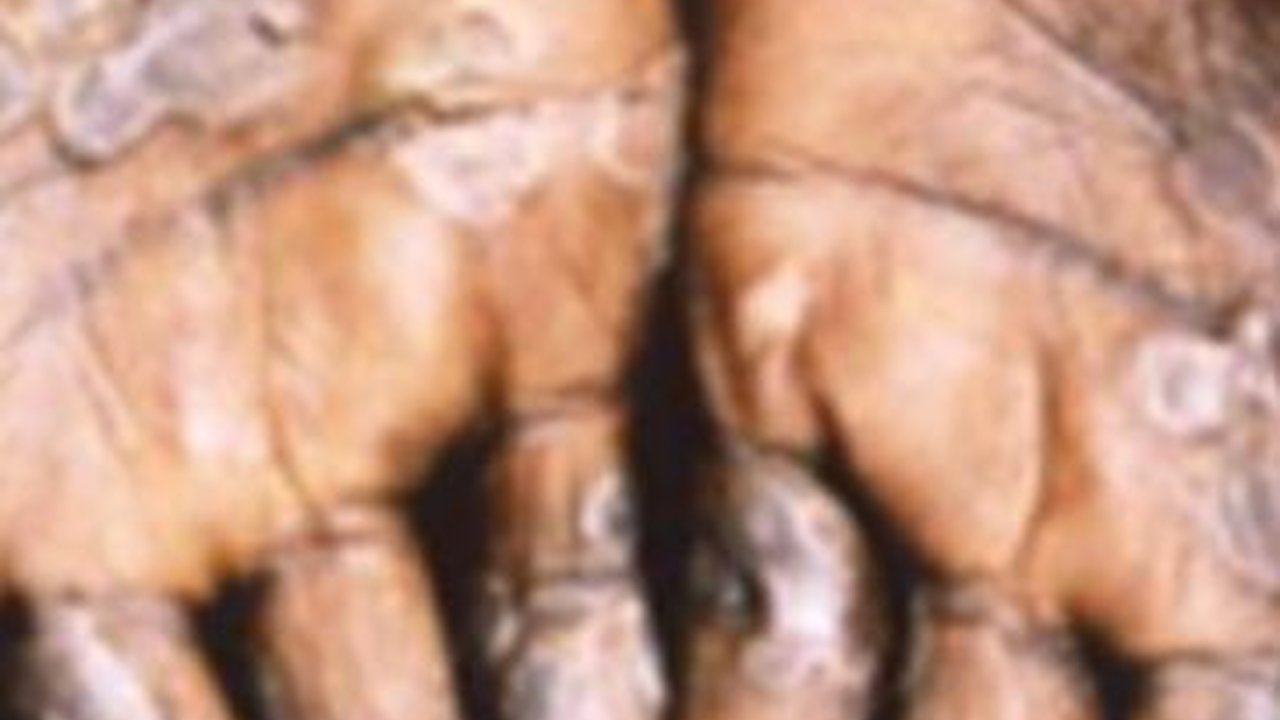 Cacar Monyet di Indonesia Diprediksi Bisa Capai 3.600 Kasus dalam Setahun