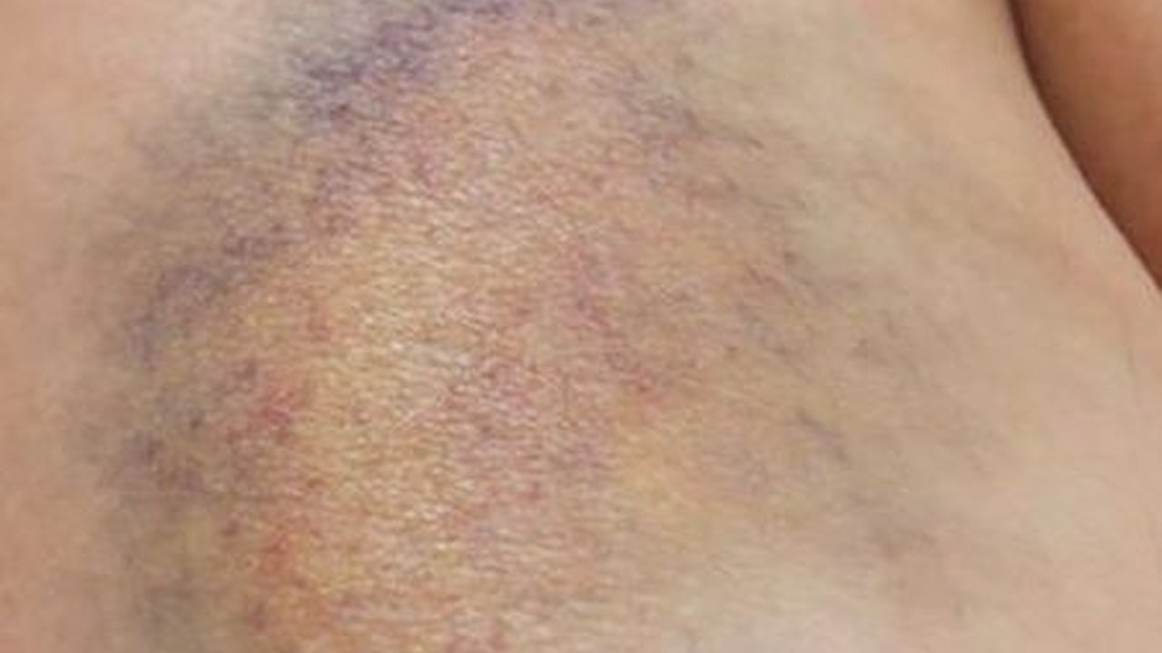Kenali 8 Penyebab Kulit Memar Tiba-tiba, Bisa Jadi Gejala Penyakit Kronis