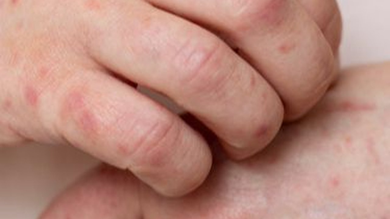 Komplikasi Cacar Air yang Harus Diwaspadai, Jangan Anggap Sepele