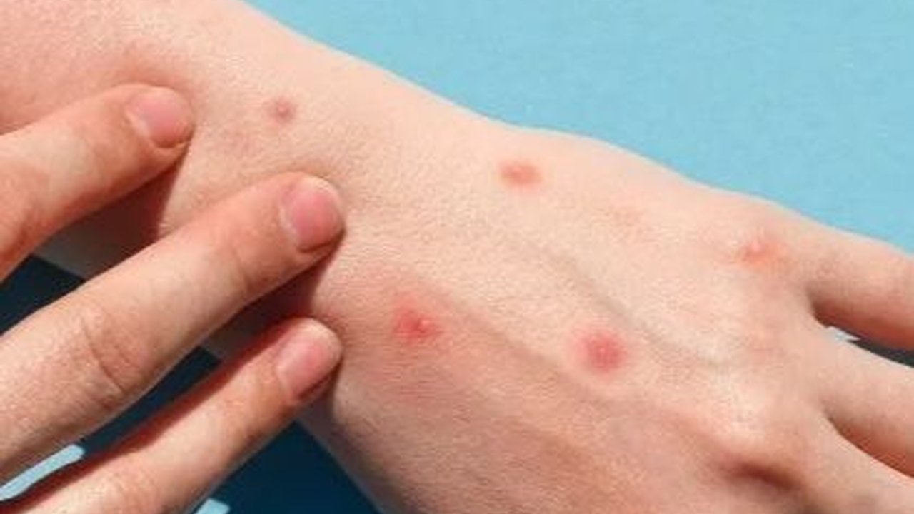 Cara Mengobati Cacar Monyet pada Anak, Kenali Gejalanya