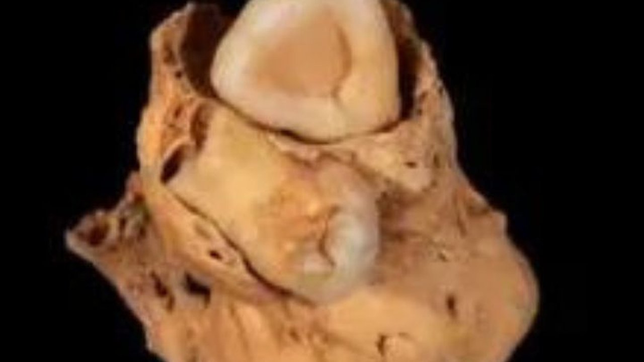 Arkeolog Temukan Kerangka Wanita Mesir Kuno Penderita Tumor Langka Bawa Jimat Penyembuh