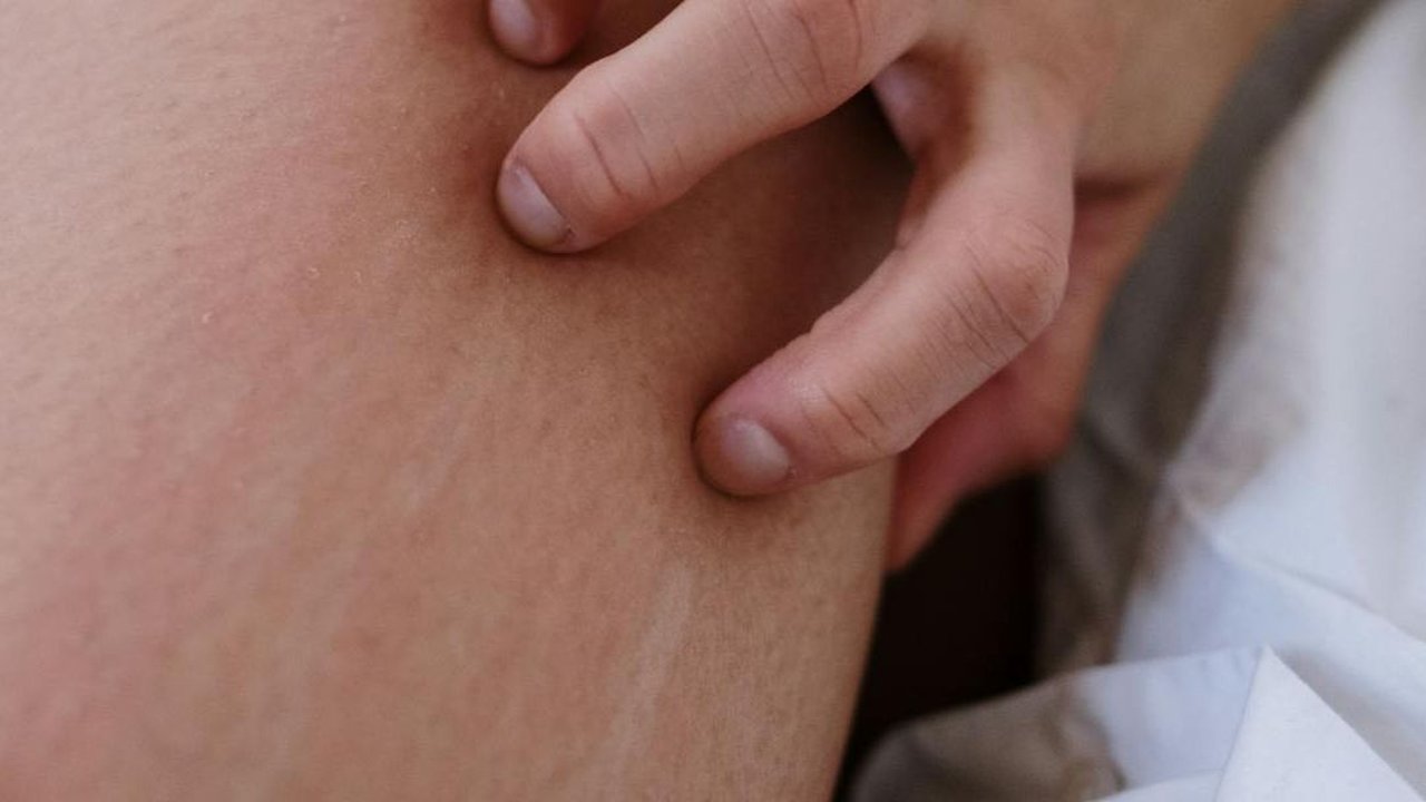 Begini Cara Meredakan Rasa Gatal di Kulit Tanpa Perlu Digaruk