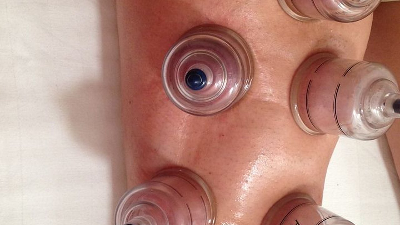 Manfaat Bekam bagi Tubuh, Ketahui Efek Sampingnya