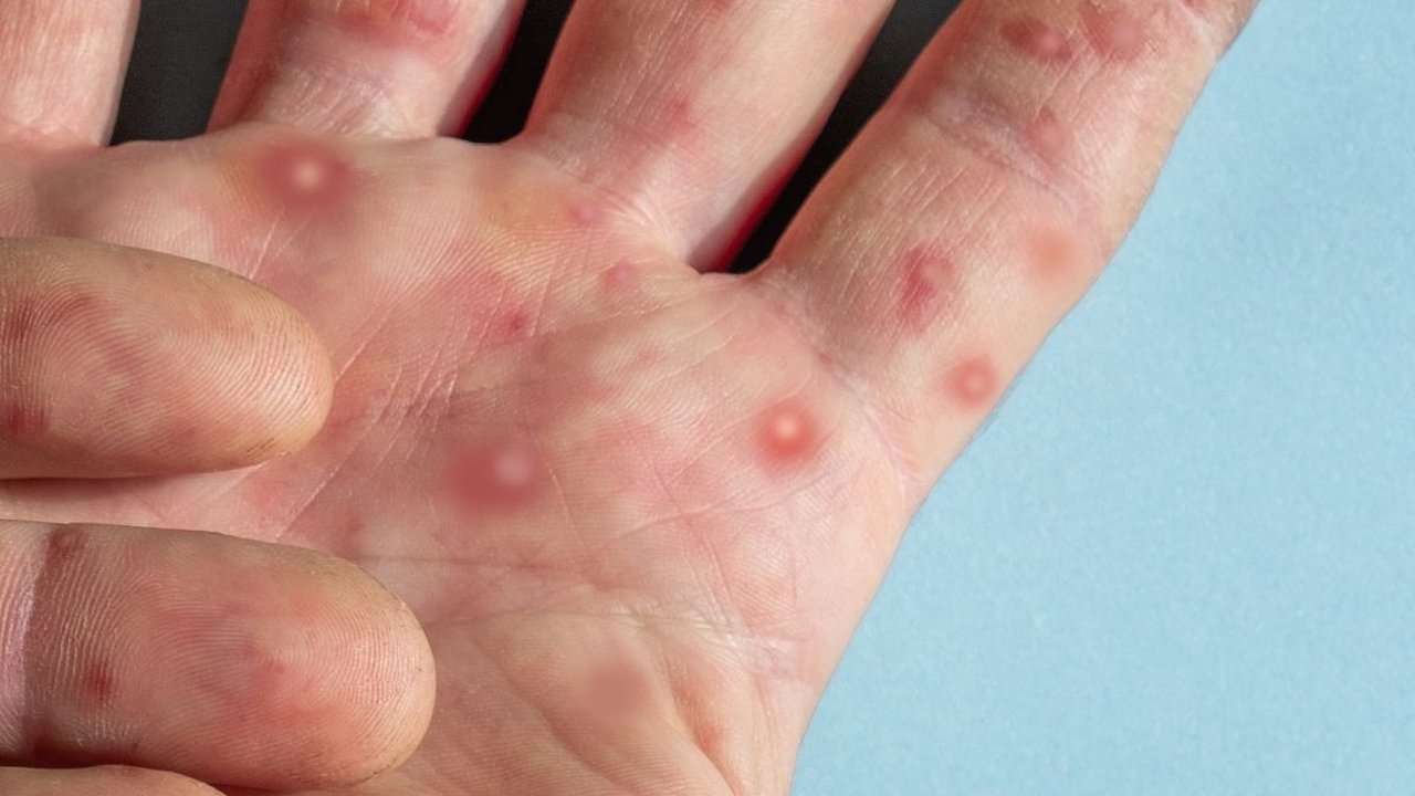 Ada Temuan 1 Kasus, Pemprov Jabar Jamin Kesiapan Tangani Kasus Cacar Monyet