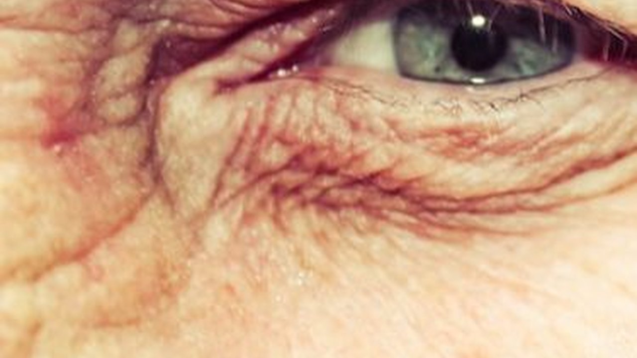 Penyebab Kebutaan pada Lansia, Kenali Gejala yang Muncul