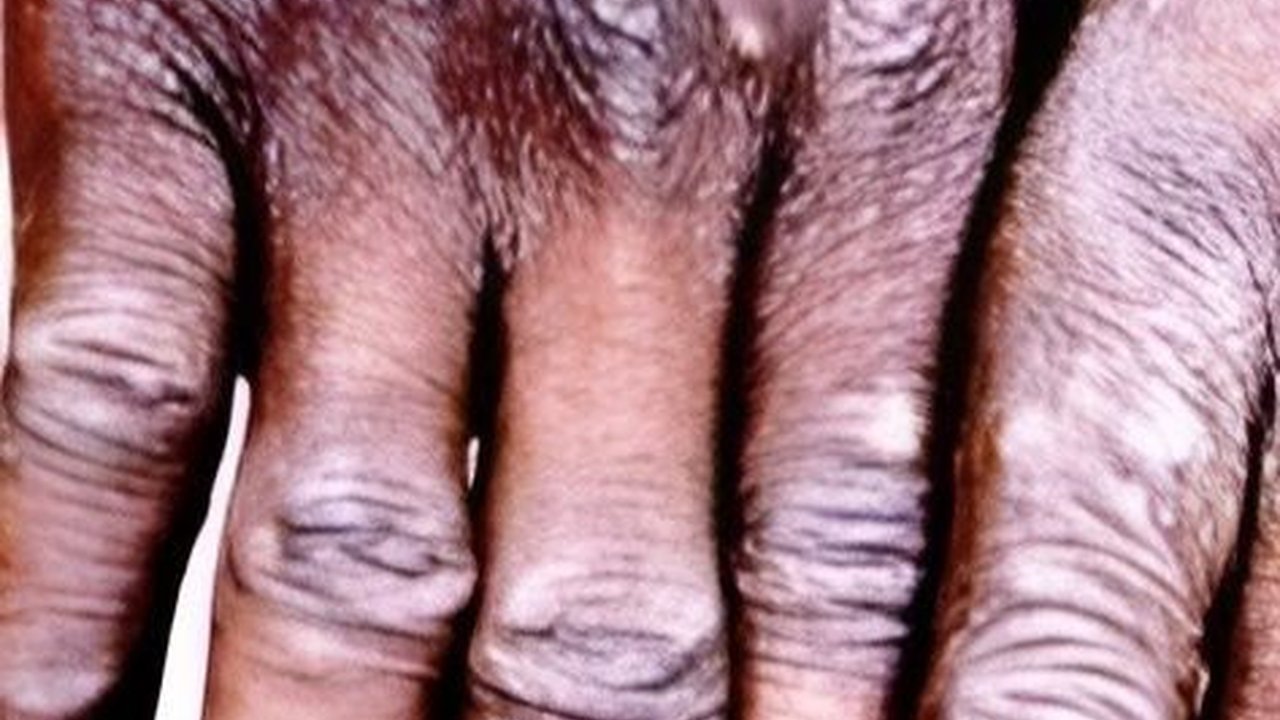 Cacar Monyet di Jakarta Capai 30 Kasus, Seluruhnya Laki-Laki yang Tertular dari Hubungan Seksual