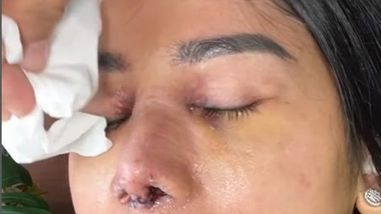 Santai Meski Tuai Cibiran, Potret Farida Nurhan Kembali Oplas Hidung Demi Penampilan Maksimal