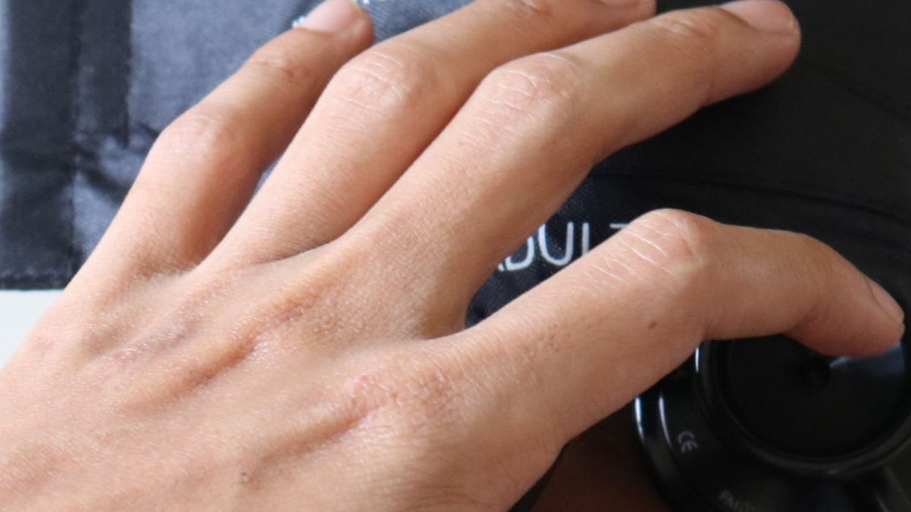 4 Penyebab Hipertensi dan Tandanya Pada Tubuh, Ketahui Faktor Resikonya