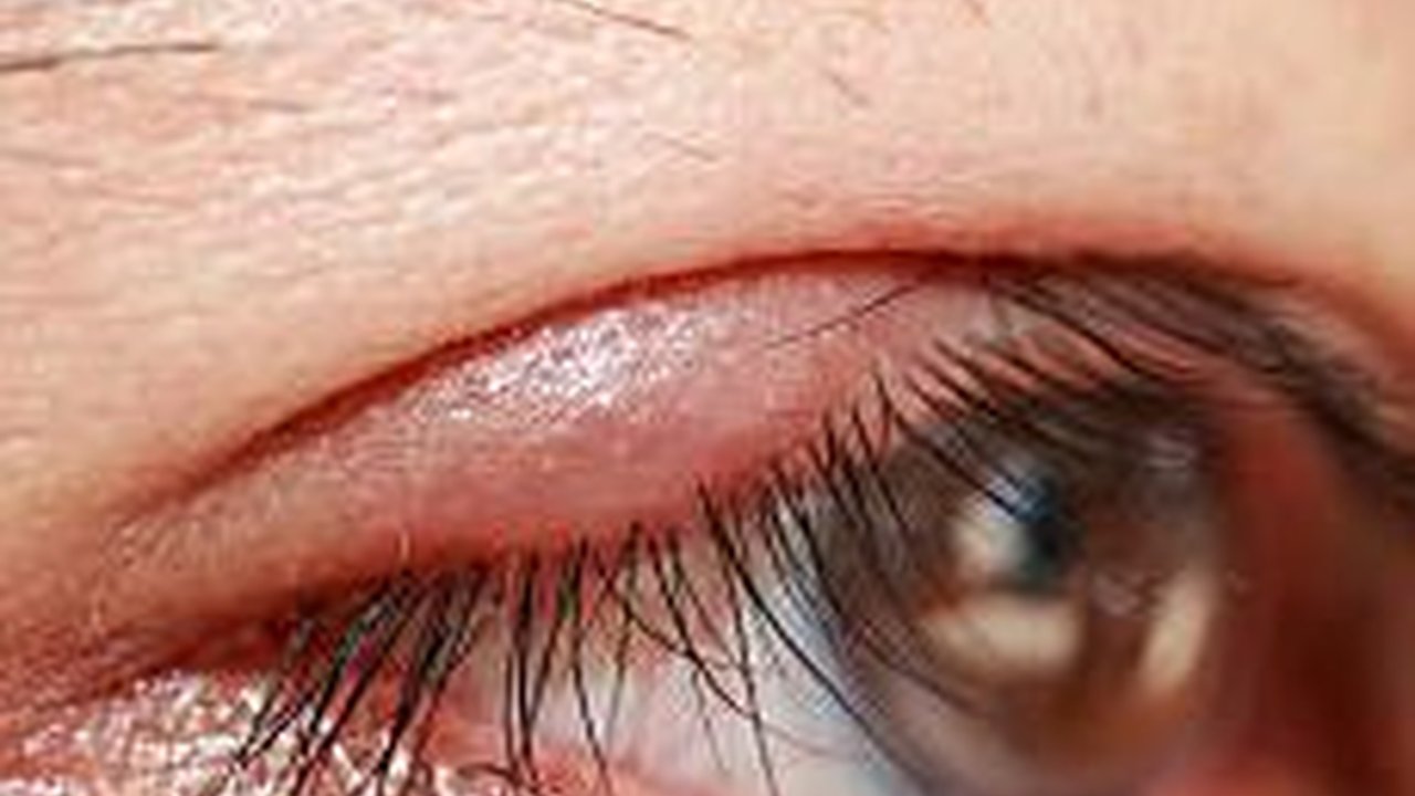 Penyebab Mata Bintitan, Ketahui Cara Mengobatinya