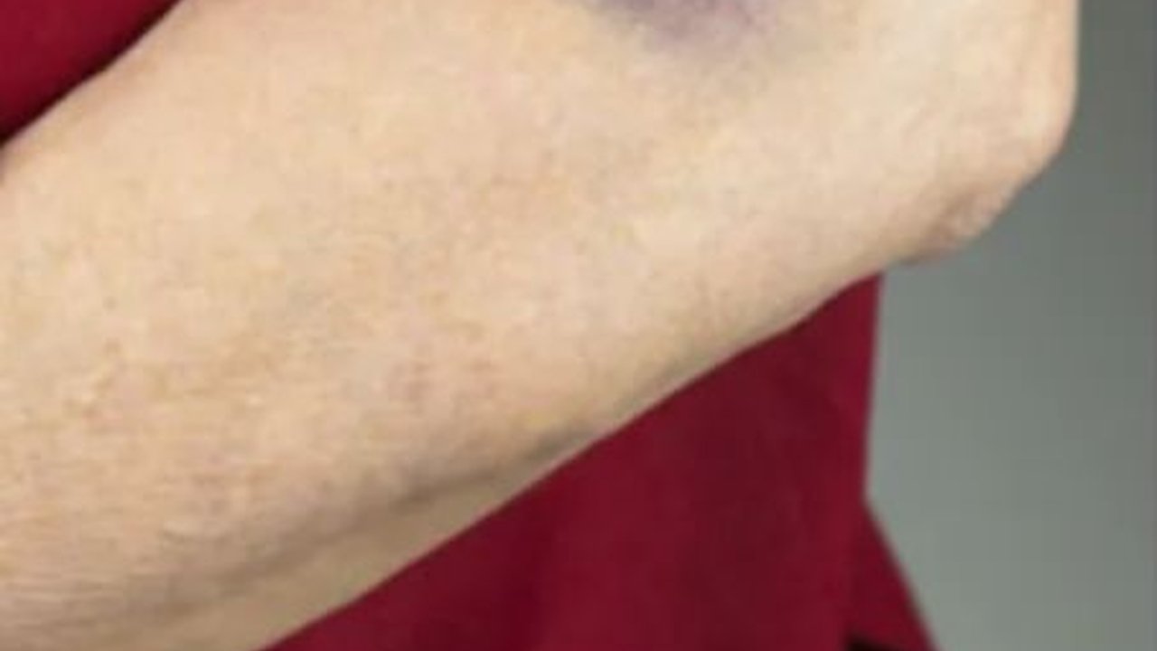Sering Tiba-Tiba Muncul Memar di Tubuh, Ini 7 Penyebabnya