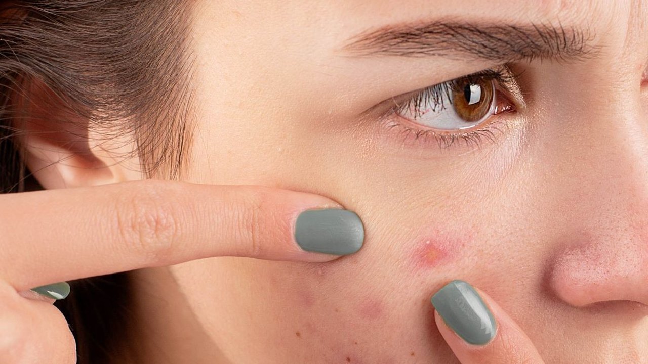 Jenis Jerawat yang Susah Hilang dan Cara Mengatasinya