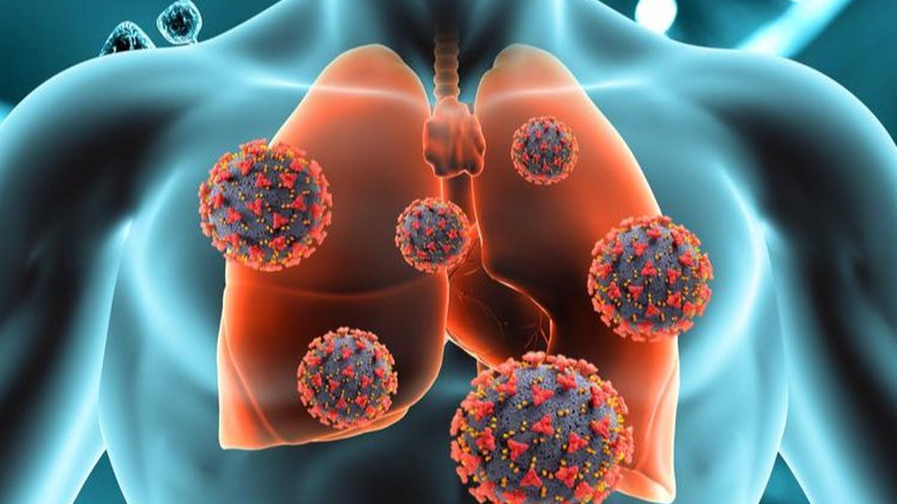Gejala TBC Paru, Penyebab, Penularan, dan Cara Pencegahannya