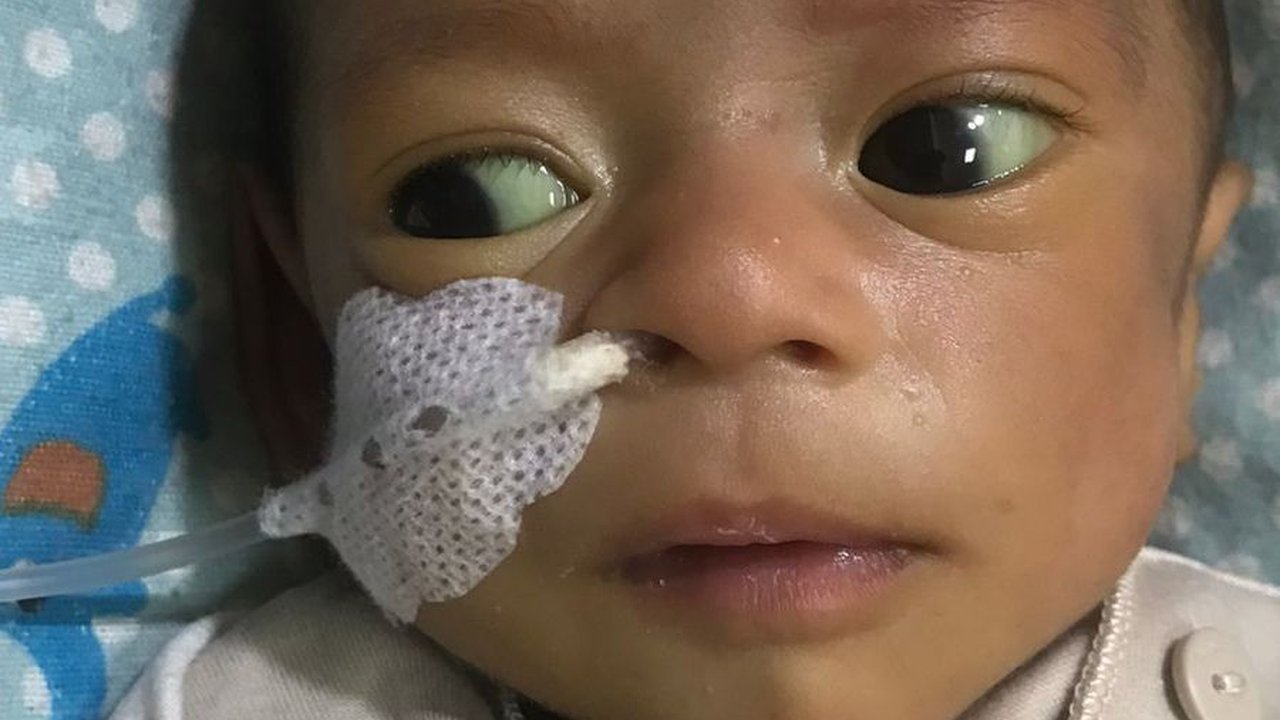 Suster Salah Kasih Susu, Bayi Dua Bulan Kritis Hingga Gizi Buruk